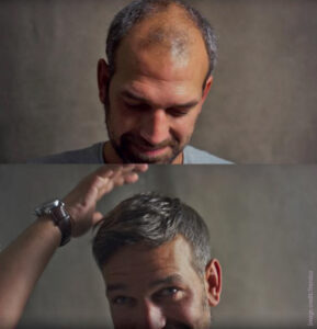 Before and after men's hair replacement system - available at Simon Constantinou Barbers Cardiff