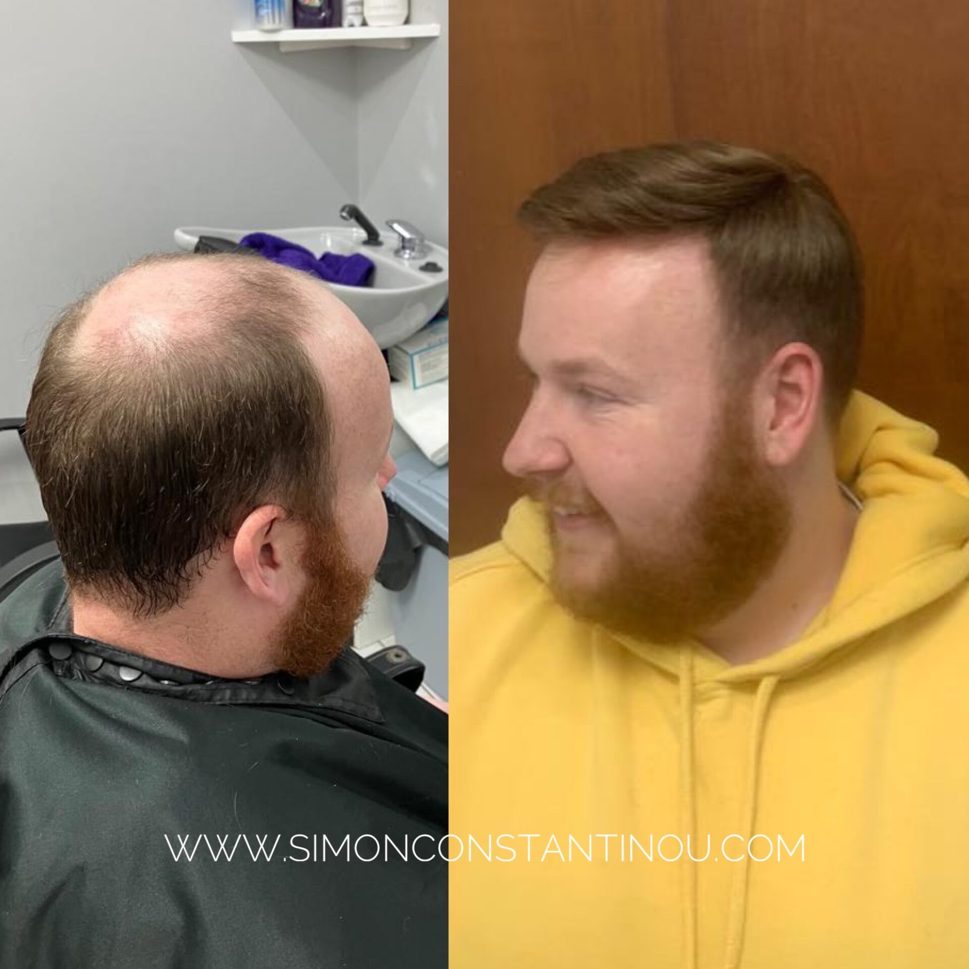 Mens hair replacement system by Simon Constantinou - Cardiff Wig Fitters  and Mens Hair System Specialists (3) | Award Winning Hair Salon, Barbers & Hair  Piece Specialist Cardiff