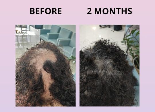 GLOWWA - Hairloss BEFORE AND AFTER. Simon Constantinou Cardiff Glowwa stockist